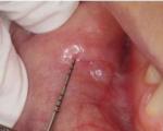 Benígne nádory ústnej dutiny